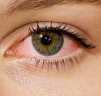 The Basics of Pink Eye