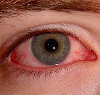 How Much Do You Know About Pink Eye?