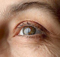 Cataracts: Prevention and Treatment