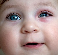 Causes, Types, and Treatment of Pink Eye