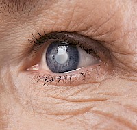 Why Cataracts Form and How We Treat Them