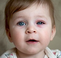 Everything to Know About Pink Eye